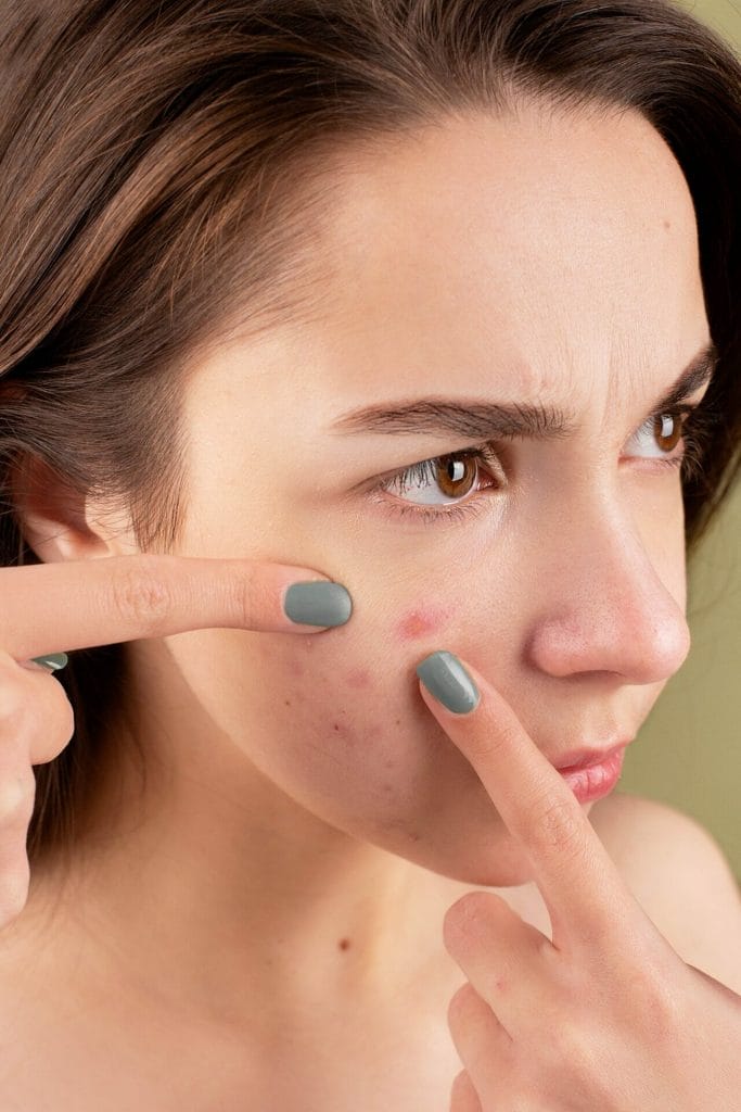 A woman about to pop a pimple with her fingers.