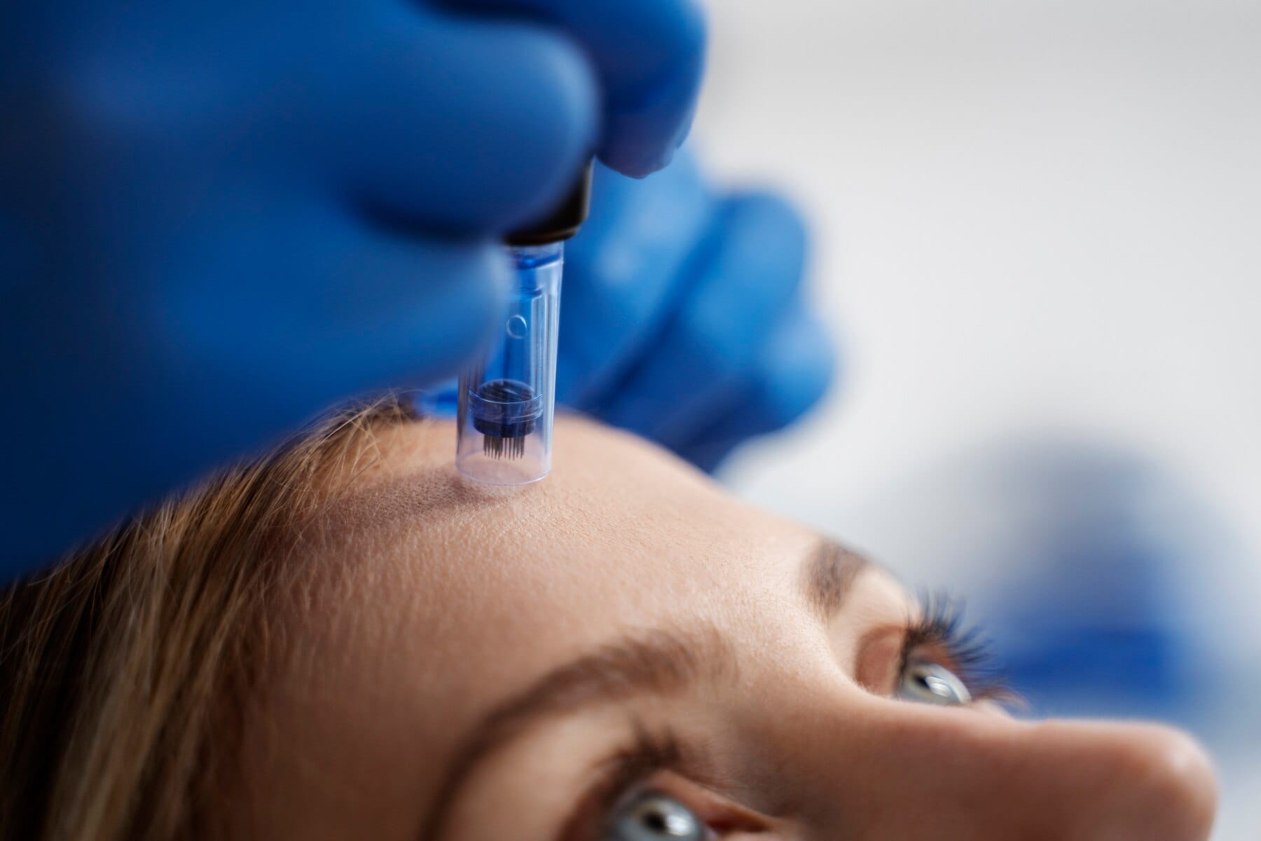A woman is undergoing a skin treatment procedure, getting her eyebrows injected with a needle.