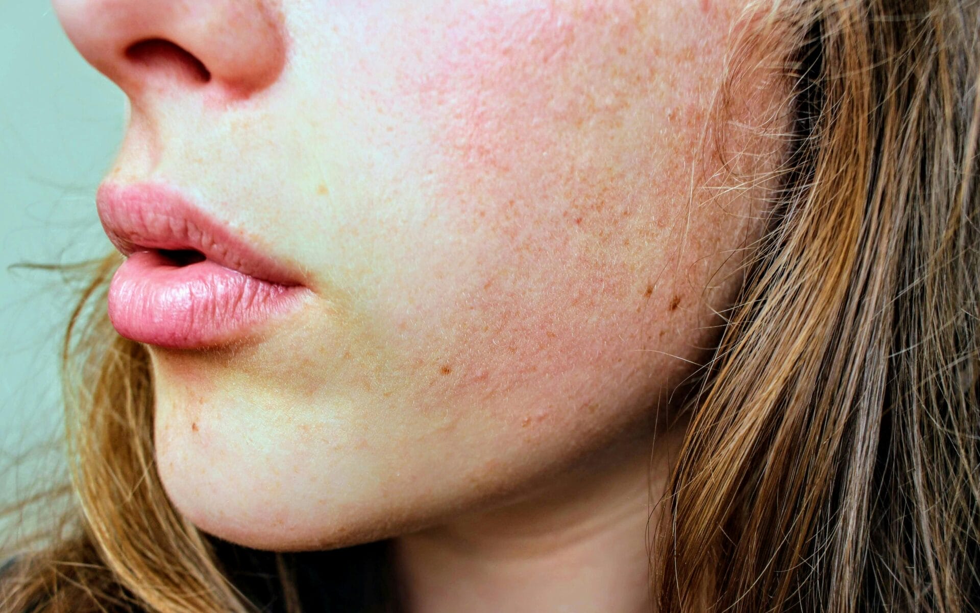 A close up of a woman's face with freckles seems to have dry skin.