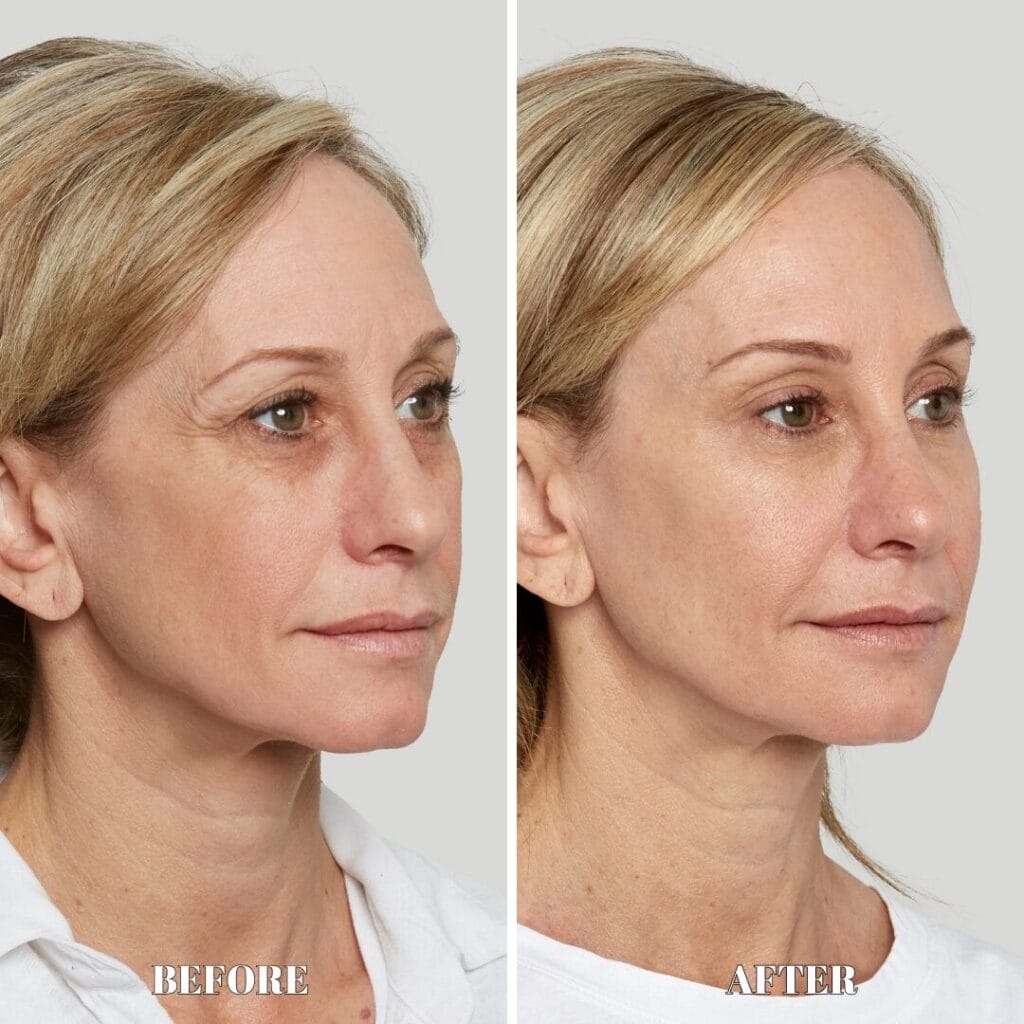 Before and after photo of a woman's face following Sculptra aesthetic treatment.