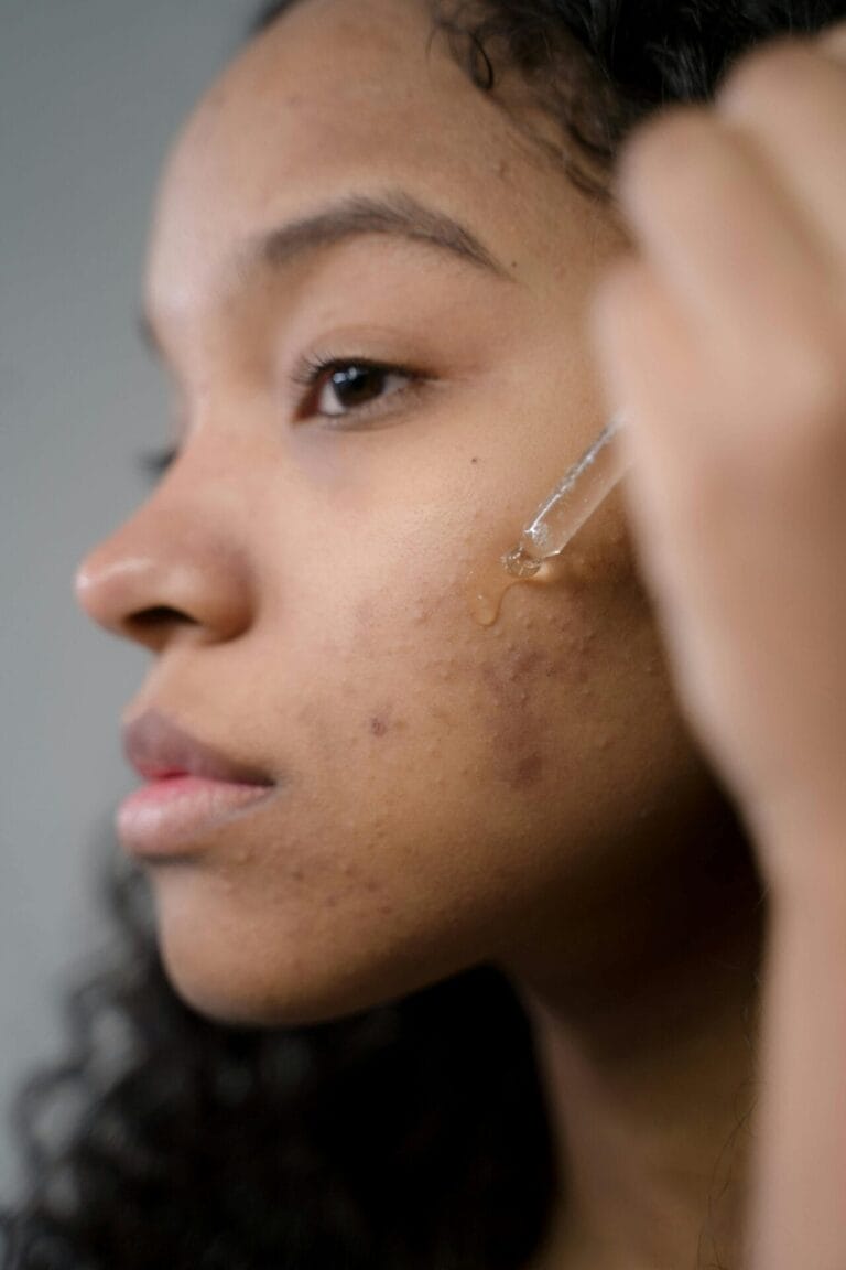 A person applies a skincare serum with a dropper to their cheek, aiming for clear skin despite visible acne and texture, as the bright summer light accentuates every detail.