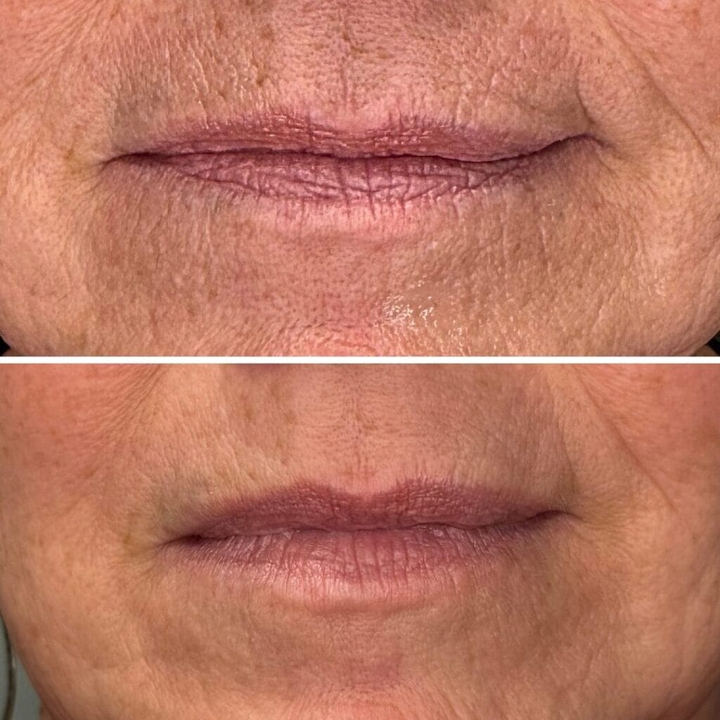 Close-up comparison of lips and surrounding skin, showing before (top) and after (bottom) treatment results with Redensity, illustrating visible reduction in wrinkles and improved skin texture.