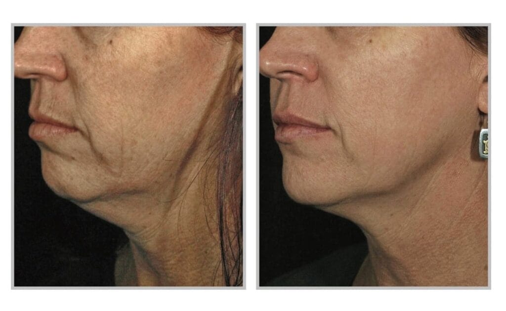 Side-by-side photos of a person's lower face and neck show visible skin tightening and reduced wrinkles in the "after" image, highlighting impressive results with Sciton SkinTyte compared to the "before" image.